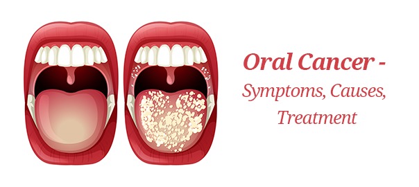 Oral Cancer Risk: